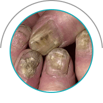 Грибок Протект