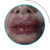 Грибок Протект