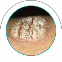 Грибок Протект